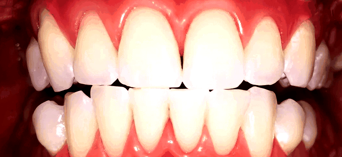 Преимущество услуги отбеливания зубов