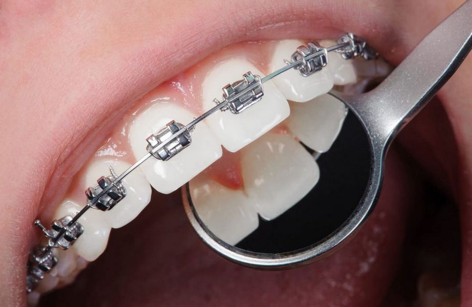 Установка зубных имплантатов «под ключ»: Исчерпывающее руководство