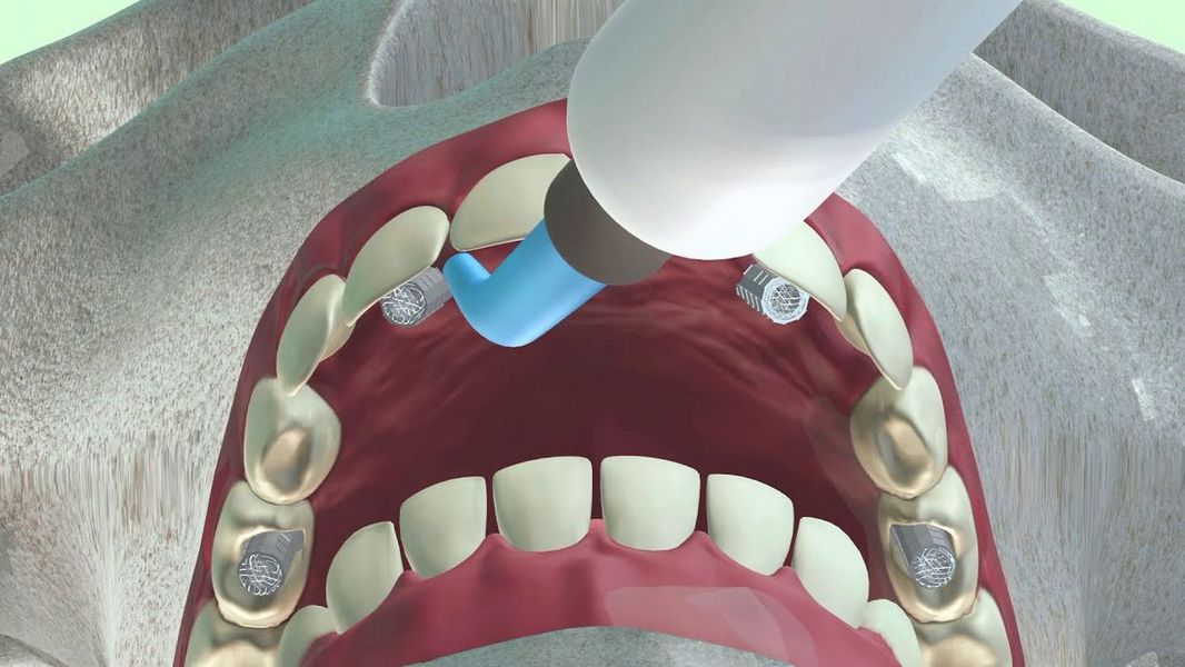 Установка зубных имплантатов "под ключ": Исчерпывающее руководство