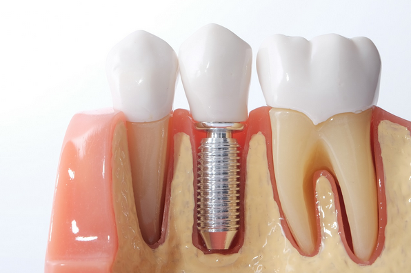 Имплантация зубов как современное решение